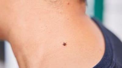 A tick on a person's neck, using permethrin to avoid tick bites concept.