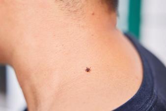 A tick on a person's neck, using permethrin to avoid tick bites concept.